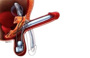 Pour vaincre les problèmes d'érection, l'implant pénien est parfois recommandé