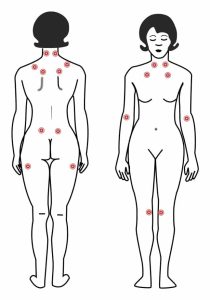Points fibromyalgie