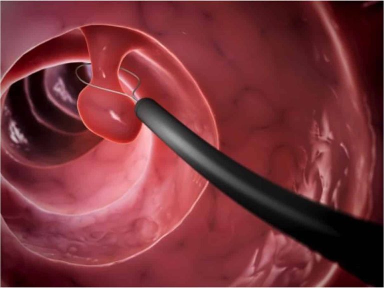 Traiter les polypes rapidement grâce un dépistage efficace