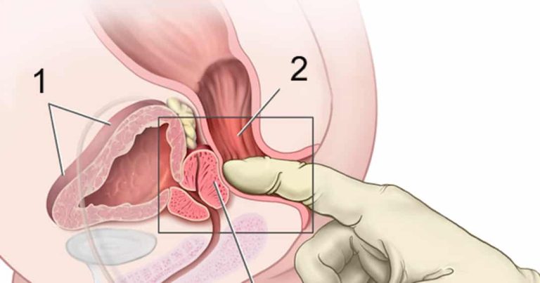 Toucher rectal