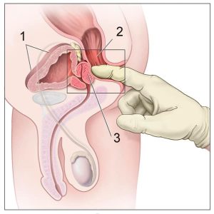 Le toucher rectal doit être pratiqué en cas de doute