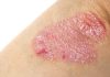 L'eczéma est souvent à l'origine de démangeaisons et irritations de la peau