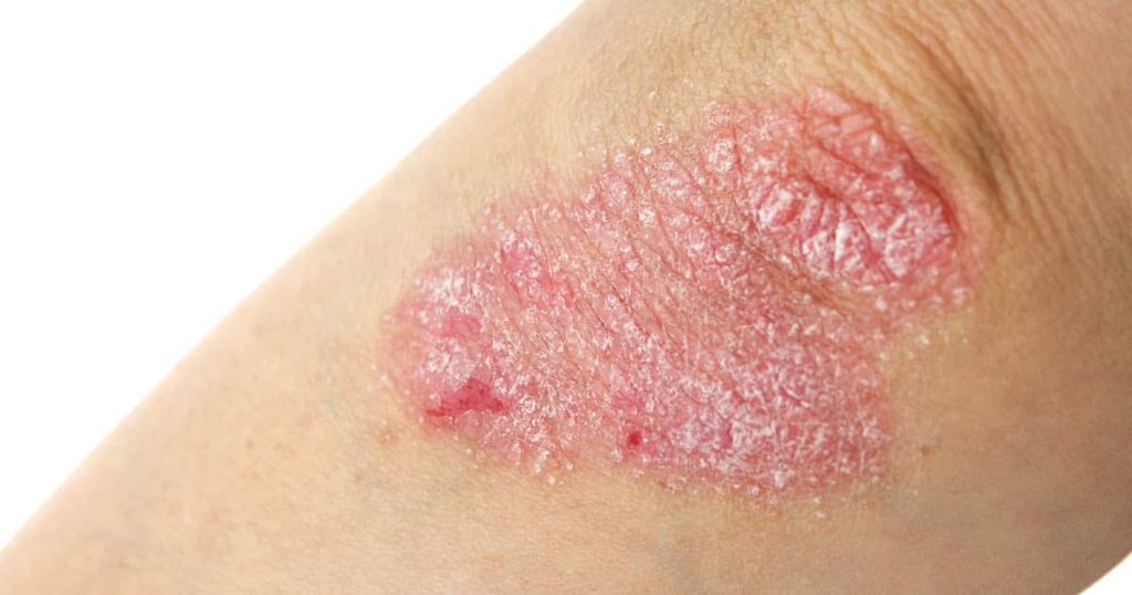 L'eczéma est souvent à l'origine de démangeaisons et irritations de la peau