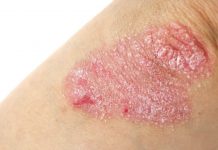 Dermatologie: mieux comprendre l’eczéma et la dermatite atopique L'eczéma est souvent à l'origine de démangeaisons et irritations de la peau