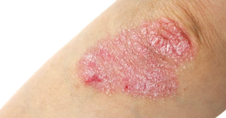 L'eczéma est souvent à l'origine de démangeaisons et irritations de la peau