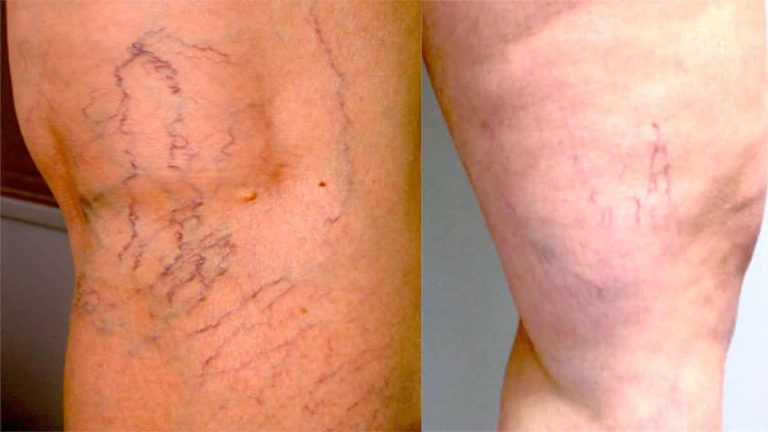 Les varices, des veines saillantes et souvent bleuâtres
