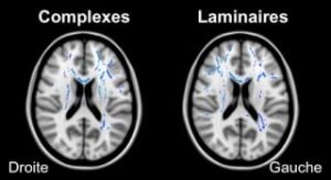 en bleu les augmentations de connectiveté structurale (points bleus) des Complexes et des Laminaires par rapport aux Contrôles. On voit sur cette coupe que l’hémisphère droit des Laminaires présente plus de régions augmentées que les Complexes.