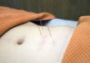 Acupuncture : mieux comprendre cette médecine douce acupuncture médecine douce Ra Santé