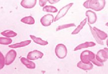 Excès de fer, symptômes et prévention de l’hémochromatose