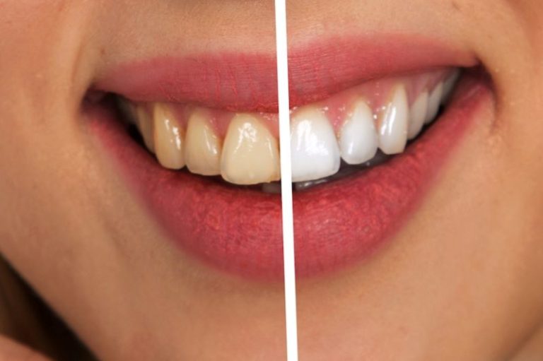 une dentition et un sourire tout aussi éclatant