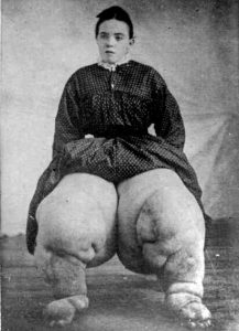 L'Elephantiasis, une maladie aussi rare qu'étrange.