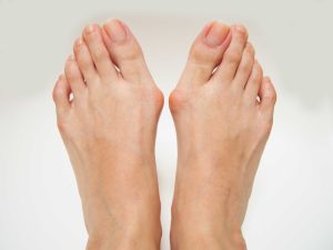 Hallux valgus oignon pied douleur deformation