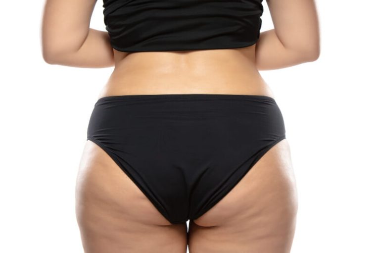 La culotte de cheval touche bon nombre de femmes, mais il est possible de s'en débarrasser