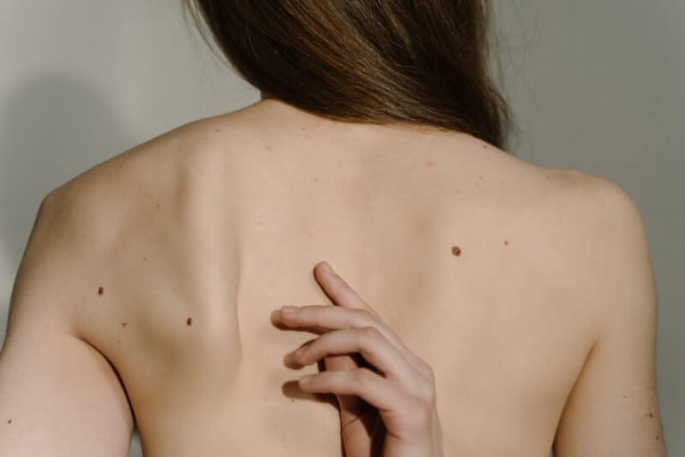 Les mélanomes sont les grains de beauté à l'origine d'un cancer. Ils sont facilement reconnaissables.