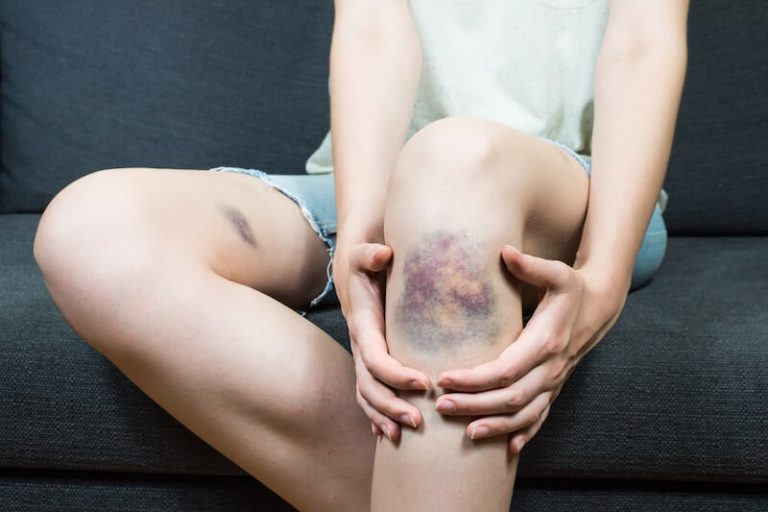 Une femme a subi un choc, laissant sur sa peau une marque bleue.