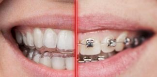 Traitement orthodontique par bagues ou gouttières ? Comment choisir ?