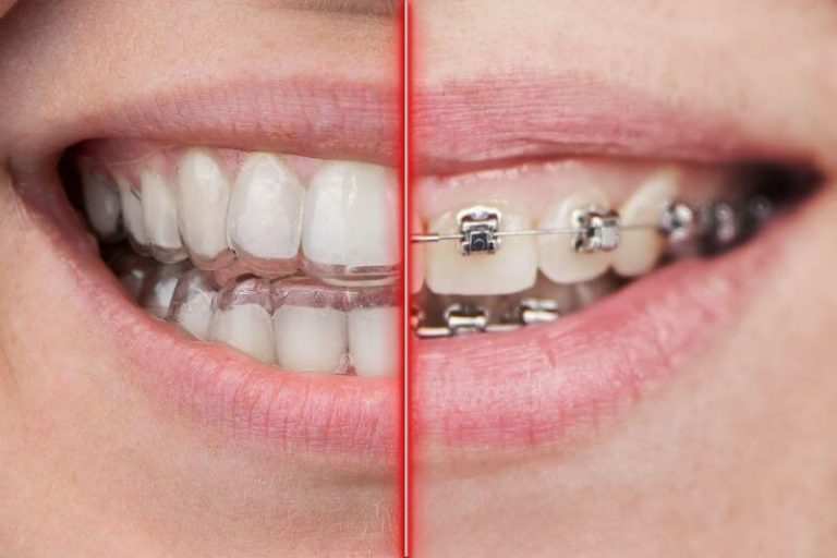 Traitement orthodontique par bagues ou gouttières ? Comment choisir ?