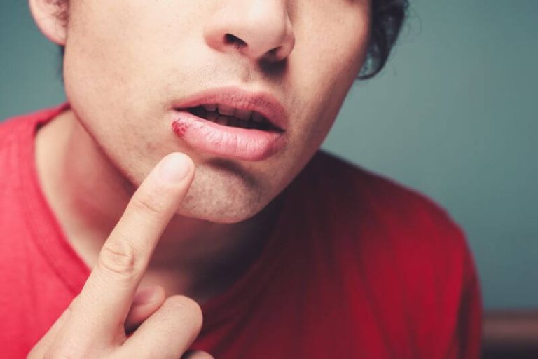 Un jeune homme avec un bouton de fièvre déjà sorti, soucieux de le traiter rapidement.