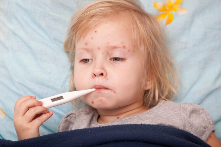 Un enfant touché par l'épidémie de rougeole qui sévit dans la région lyonnaise.