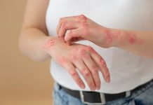 Une patiente atteinte de lupus est prise de démangeaisons dues à des plaques rouges localisées sur son bras.