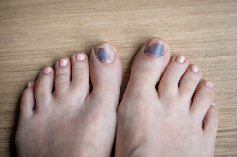 Des pieds avec les ongles bleus.