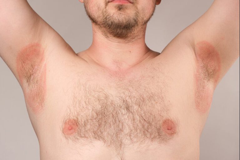 Un homme qui a des boutons de chaleur sous les bras.