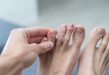 Quintus varus : quels sont les traitements naturels de cette déformation de l’orteil ? Un homme ave un pied déformé à cause d'un Quintus Varus.