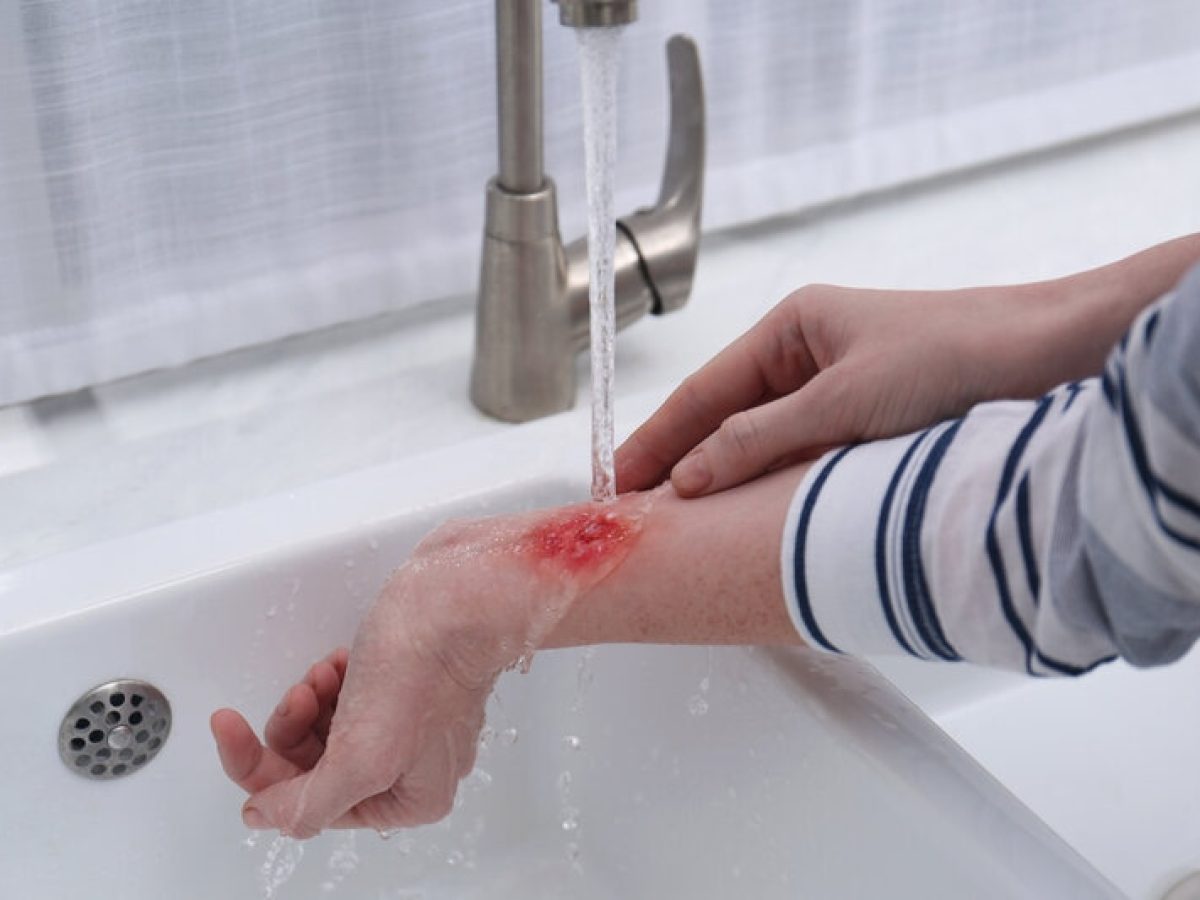 Comment ragir en cas de brlure ?