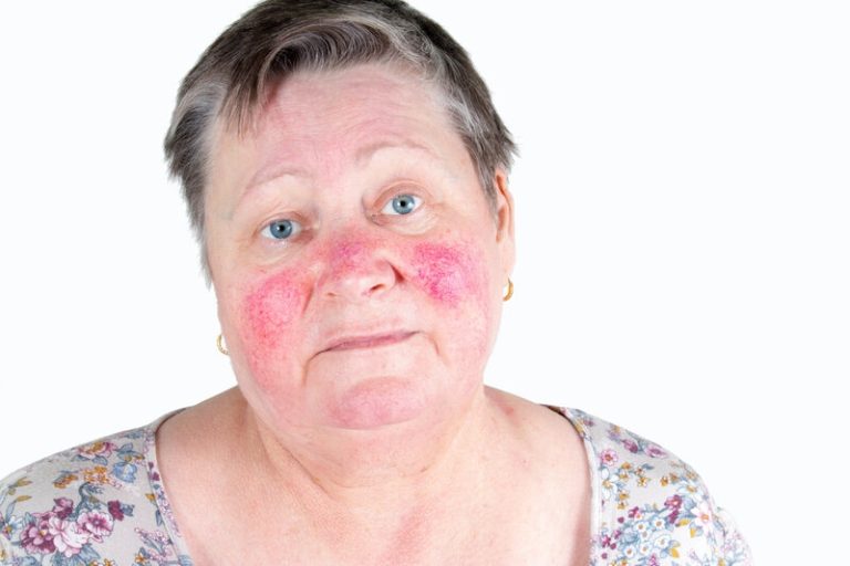 Une femme adulte avec les joues rouges atteinte de rosacée.