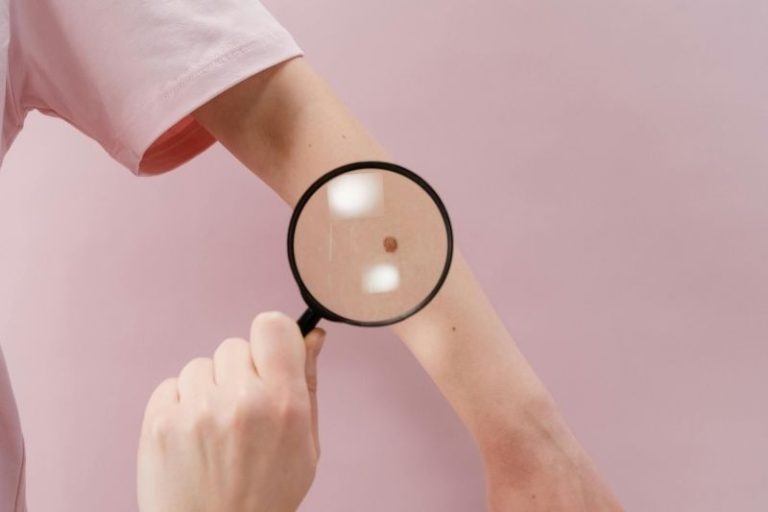 Un spécialiste de santé examine un grain de beauté pour déterminer s'il s'agit d'un mélanome.