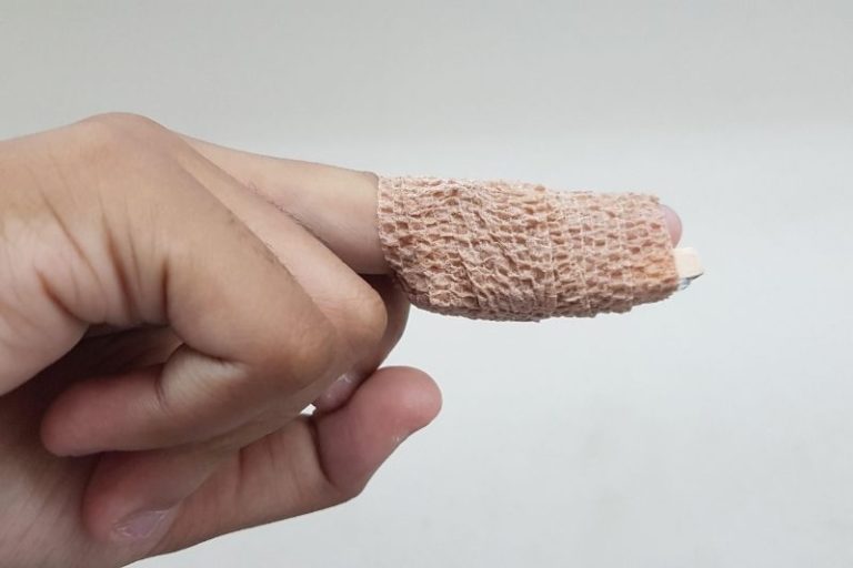 Un doigt en maillet en cours de rétablissement.