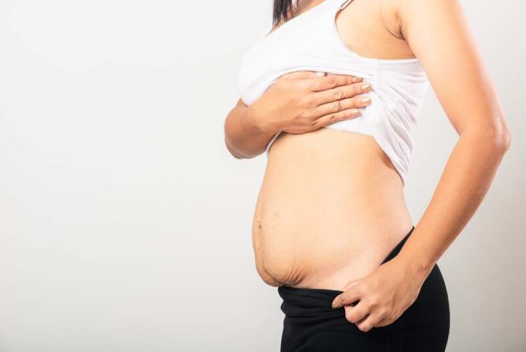 Une femme montrant son ventre post-accouchement.