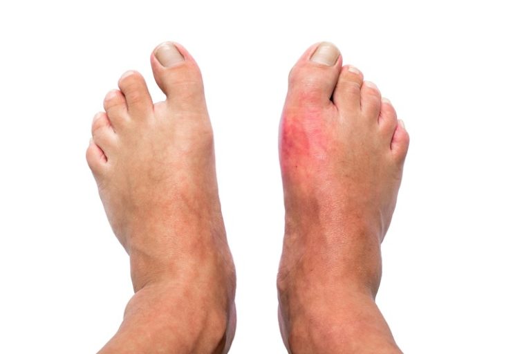 Représentation visuelle d'une crise de goutte sur l'orteil.