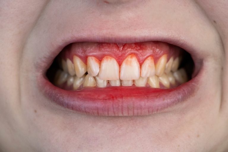 Une dentition avec une inflammation visible des gencives.
