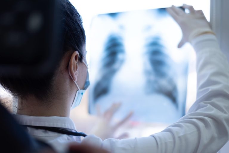 Un médecin en train d'analyser le scanner des poumons pour détecter un potentiel cancer du poumon.
