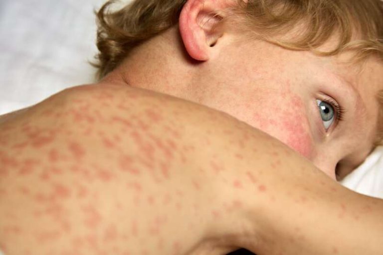 Un enfant malade à cause de la rougeole.