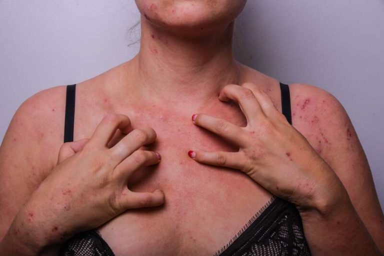 Une femme infectée par la gale qui se gratte jusqu'au sang à cause des démangeaisons.