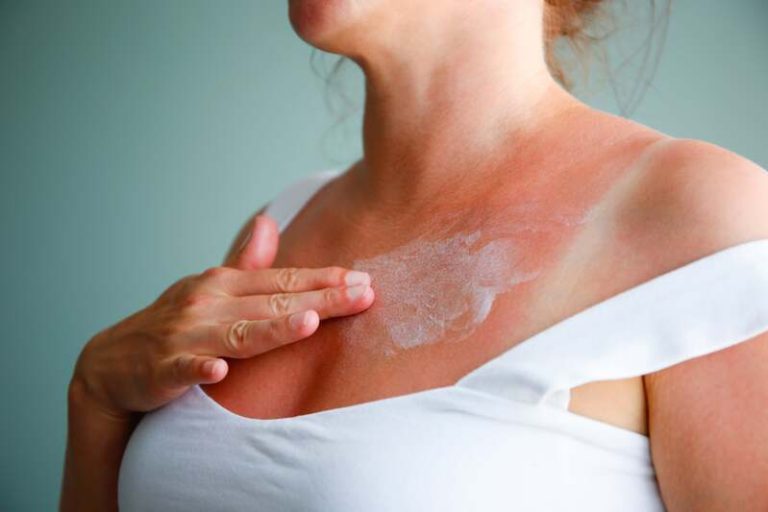 Une femme avec la peau rouge en réaction au mélange de crème solaire et d'antimoustique.