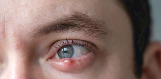 Yeux rouges, paupière gonflée : et si c’était un orgelet ? Un homme avec un oeil rouge et une paupière gonflée comme un orgelet.