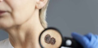 Une femme avec une tache noire sur la peau, signe de cancer de la peau.