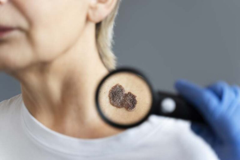 Une femme avec une tache noire sur la peau, signe de cancer de la peau.