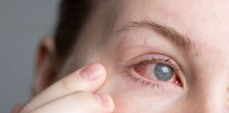 Yeux rouges, douleur, vision floue : et si c’était plus grave qu’une conjonctivite ? Une femme avec l'oeil rouge atteinte d'une kératite amibienne.