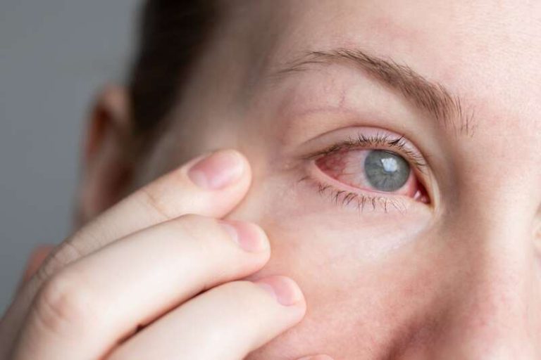 Une femme avec l'oeil rouge atteinte d'une kératite amibienne.