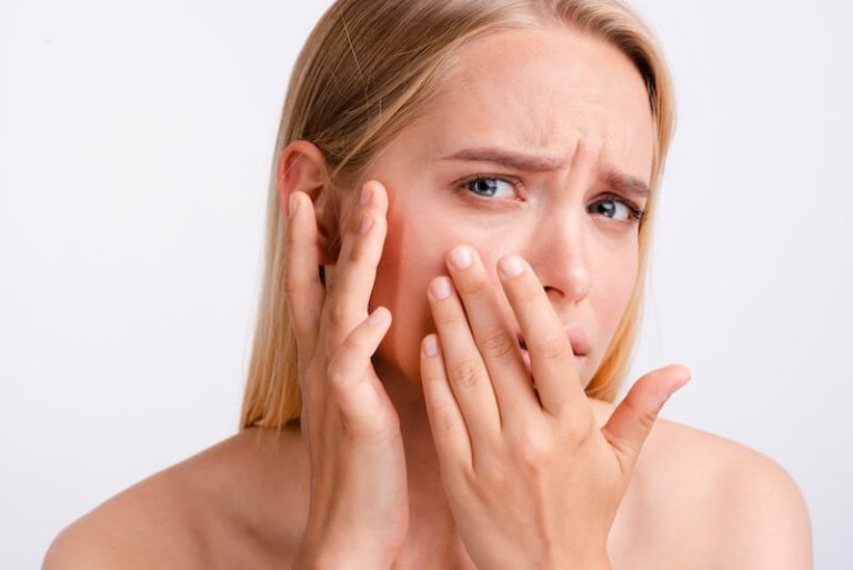 Une jeune femme souffrant d'acné, aggravée par le soleil.
