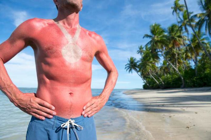 sun burn burn lines sun tatoo tiktok tendance coup de soleil cancer peau mélanome Ma Santé Un homme qui a succombé à la tendance sun tatoo de TikTok.