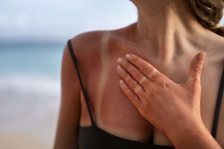 Une jeune fille qui suit la tendance burn lines qui fait fureur sur tiktok.