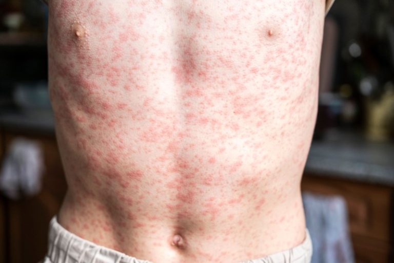 Un homme infecté par la rougeole qui voit les symptômes apparaître sur son corps.