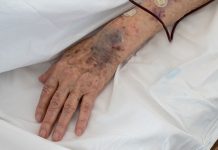 Une personne âgée qui souffre d'insuffisance veineuse, comme Donald Trump si l'on écoutait les rumeurs.