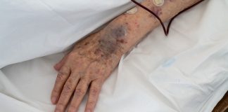 États-Unis : quelle est cette maladie veineuse dont Donald Trump est atteint ? Une personne âgée qui souffre d'insuffisance veineuse, comme Donald Trump si l'on écoutait les rumeurs.