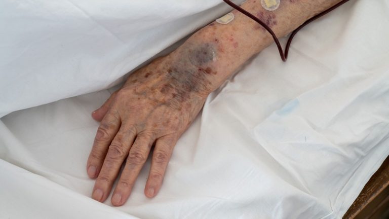 Une personne âgée qui souffre d'insuffisance veineuse, comme Donald Trump si l'on écoutait les rumeurs.